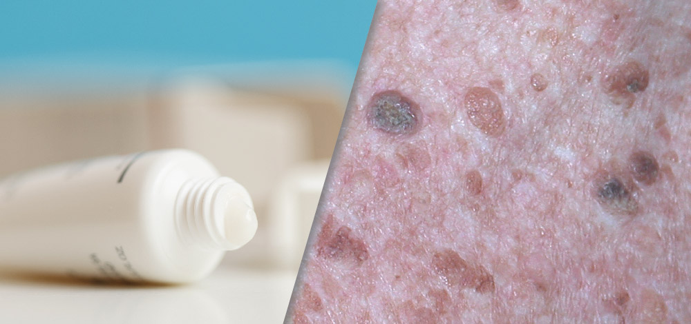 image of Seborrheic Keratoses skin