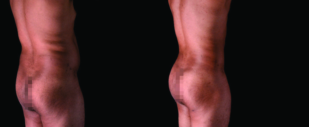 Before and after Image of male buttock augmentation 