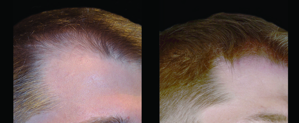 Before and after close up of male hairline from PRP/ACell injections