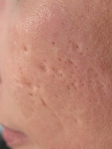 acne atrophic scar presentation with ice pick, rolling and boxcar scars on cheeks