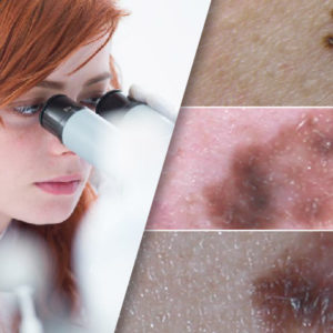 Metastatic Melanoma