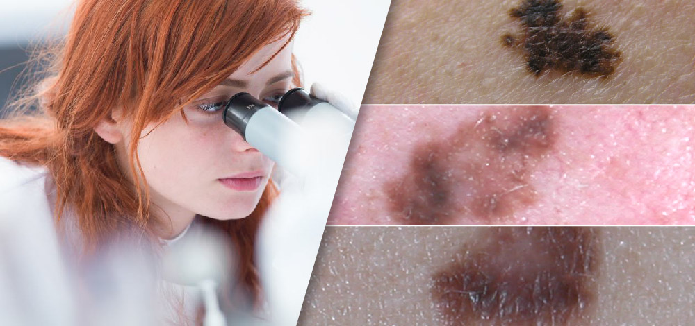 Metastatic Melanoma