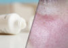 image of female face affected by rosacea and o topical cream tube