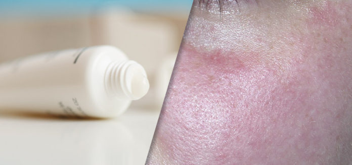 image of female face affected by rosacea and o topical cream tube