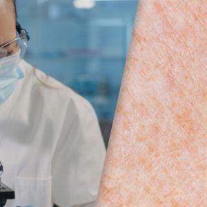 Janus Kinase and Tyrosine Kinase Inhibitors in Dermatology: Image