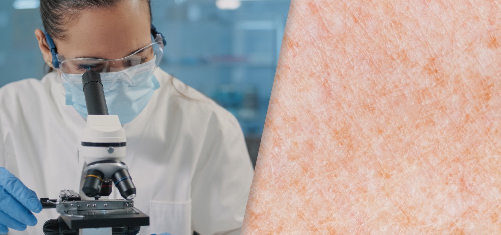 Janus Kinase and Tyrosine Kinase Inhibitors in Dermatology: Image