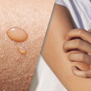 picture of itching skin, woman scratching her arm
