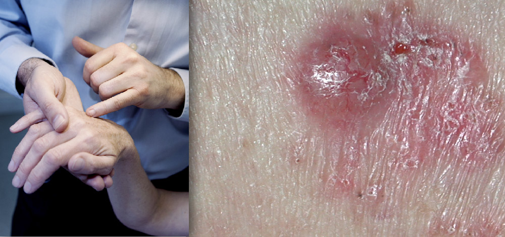 Non-melanoma Skin Cancers