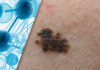 Non-Invasive Gene Expression Testing to Rule Out Melanoma