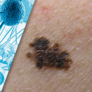 Non-Invasive Gene Expression Testing to Rule Out Melanoma