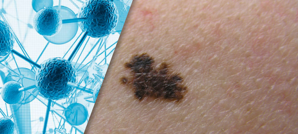Non-Invasive Gene Expression Testing to Rule Out Melanoma