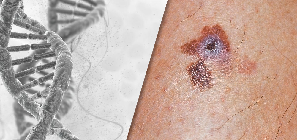 Melanoma Gene Expression Testing