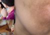Melasma and Post Inflammatory Hyperpigmentation: Management Update and Expert Opinion