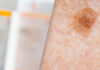 methotrexate tube and skin