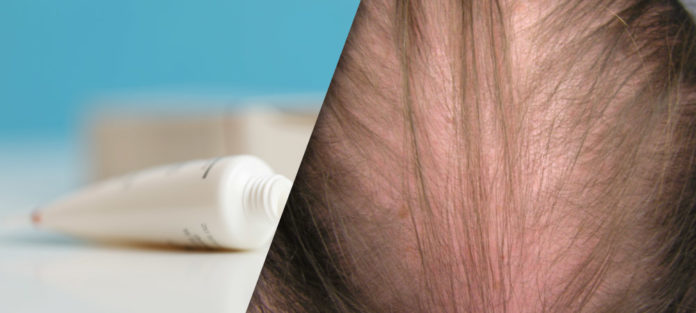5% Minoxidil: Treatment for Female Pattern Hair Loss