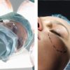 A Comprehensive Guide to MOHS SURGERY