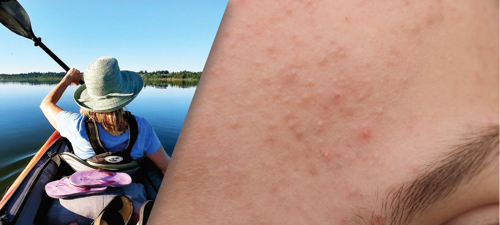 What's New in Acne Treatment in Canada?