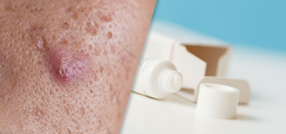 picture collage of acne face and topical cream