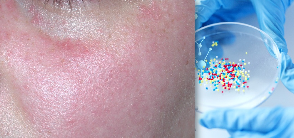 Oral Therapy for the Treatment of Rosacea