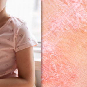 picture of sad child and skin affected by psoriasis
