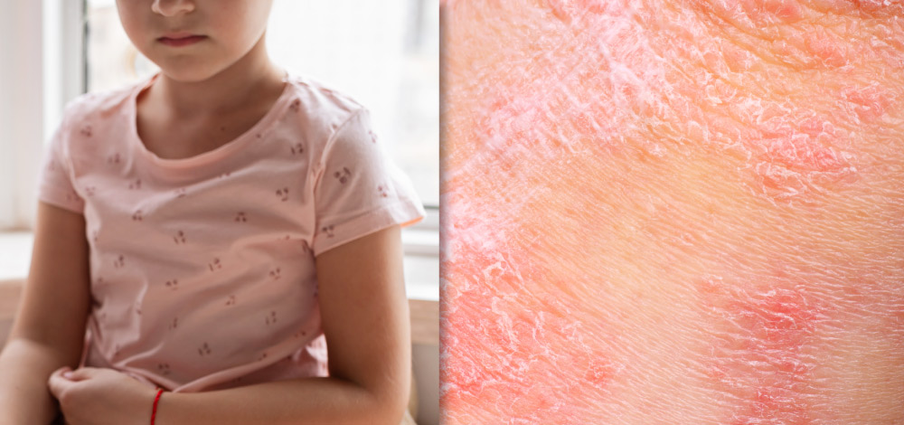 picture of sad child and skin affected by psoriasis
