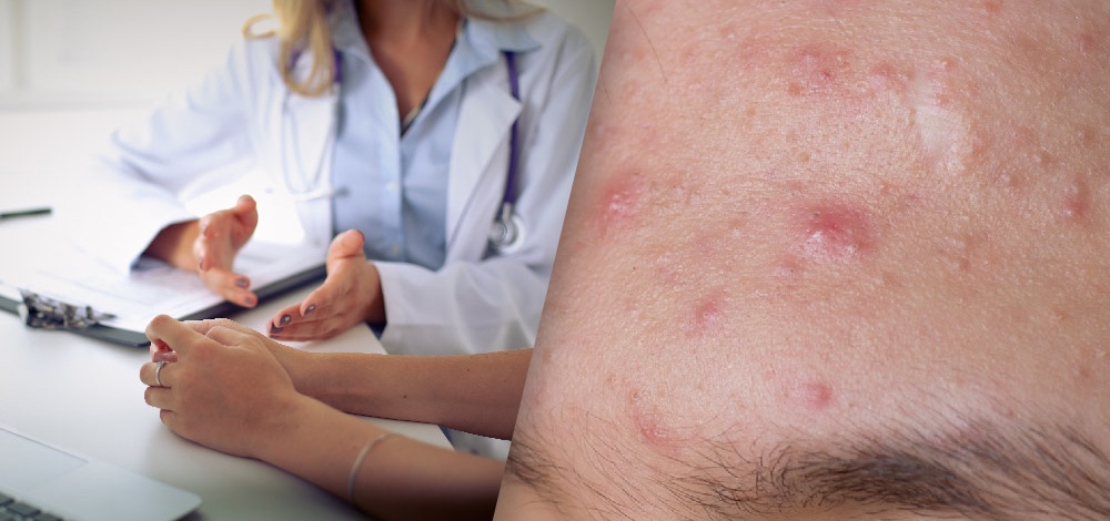 A Physician's Guide to Treating Acne