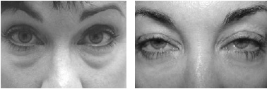 Pre- and post-operative images of patient with lower eyelid pseudoherniated fat pads and 3 months following transconjunctival blepharoplasty and erbium