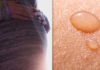 Pregnancy-Specific Skin Disorders