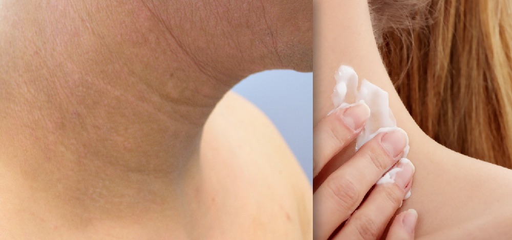 Propylene Glycol: An Often Unrecognized Cause of Allergic Contact Dermatitis in Patients Using Topical Corticosteroids