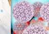 A Review of Fabry Disease