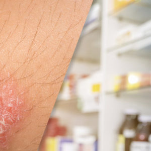 image of woman applying cream on her arm with psoriasis