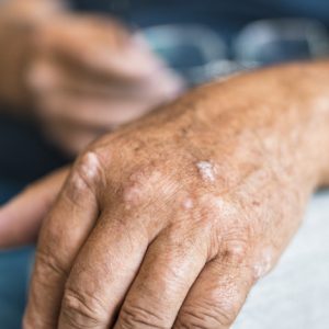 image of a man with hand with signs of psoriasis