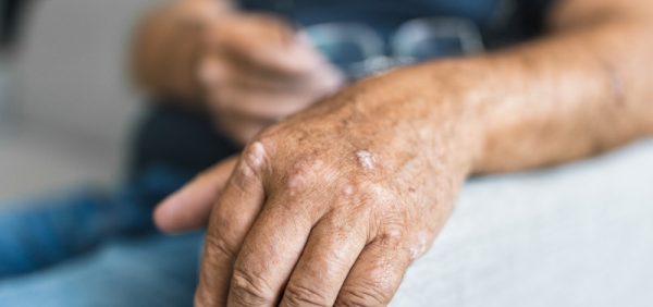 image of a man with hand with signs of psoriasis