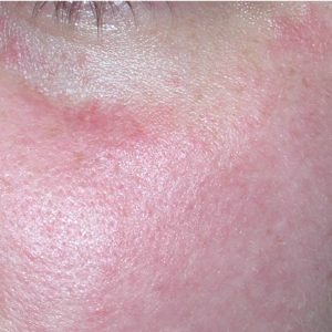 PDF: Real-World Efficacy of Azelaic Acid 15% Gel for the Reduction of Inflammatory Lesions of Rosacea
