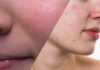The Role of Skin Care in Optimizing Treatment of Acne and Rosacea