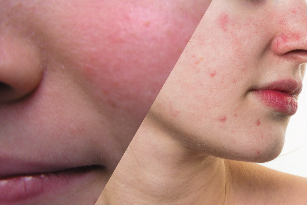 The Role of Skin Care in Optimizing Treatment of Acne and Rosacea