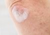 picture of men's elbow affected by psoriasis