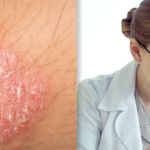 image of researcher looking at skin, presumably studying TYK2 Inhibition Psoriasis