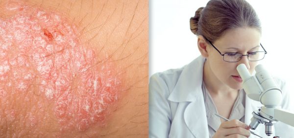 image of researcher looking at skin, presumably studying TYK2 Inhibition Psoriasis