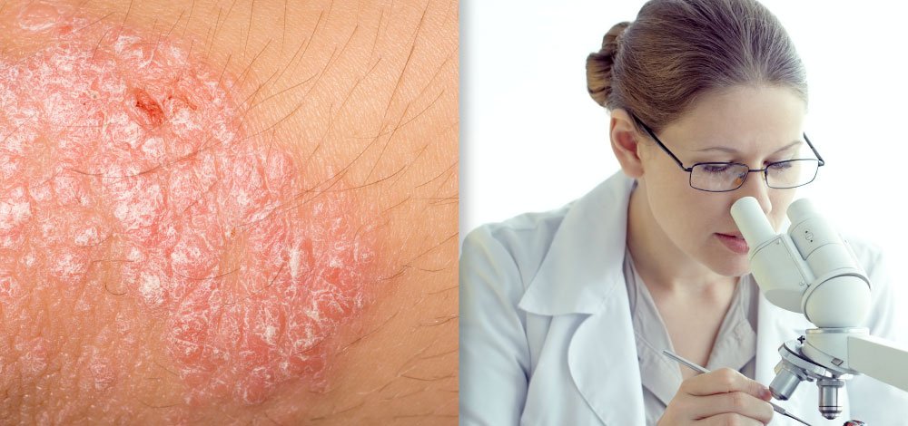 image of researcher looking at skin, presumably studying TYK2 Inhibition Psoriasis