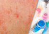 Steroid-Sparing Properties of Emollients in Dermatology