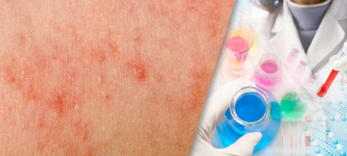 Steroid-Sparing Properties of Emollients in Dermatology