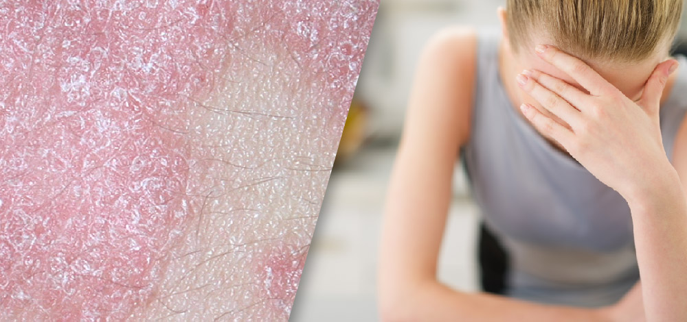 Suicidal Ideation and Behaviour in Psoriasis, Brodalumab image