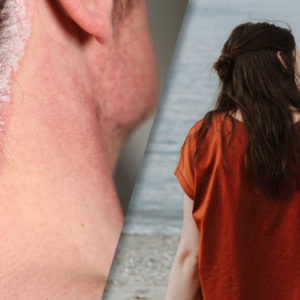 image for concept of suicidal behaviour and psoriasis