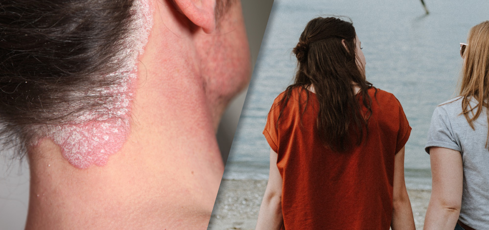 image for concept of suicidal behaviour and psoriasis