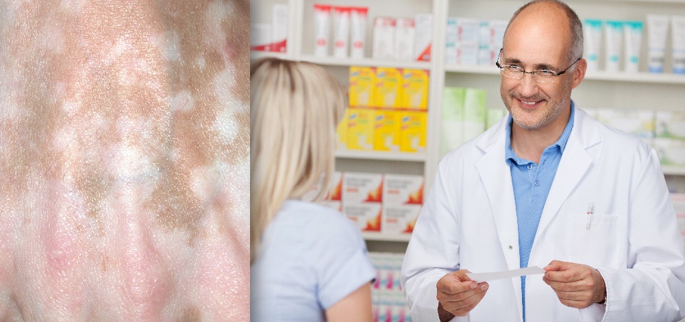 Use of Tacrolimus Ointment in Vitiligo Alone or in Combination Therapy