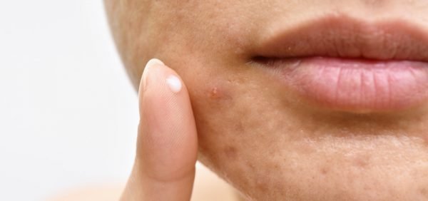 Image of Tazarotene Lotion being applied to acne face