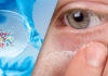 Seborrheic Dermatitis Update