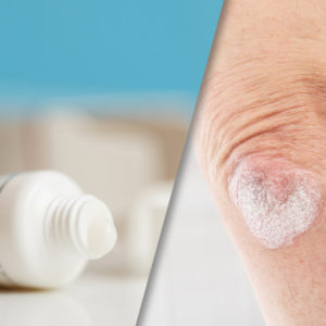 Tildrakizumab for psoriasis picture