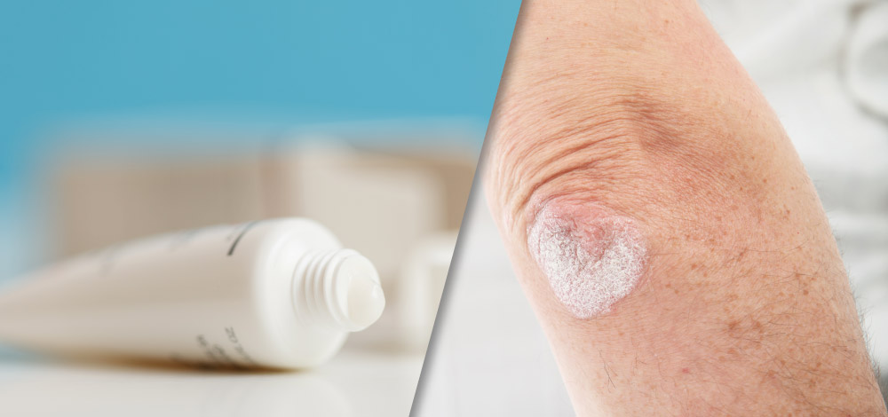 Tildrakizumab for psoriasis picture